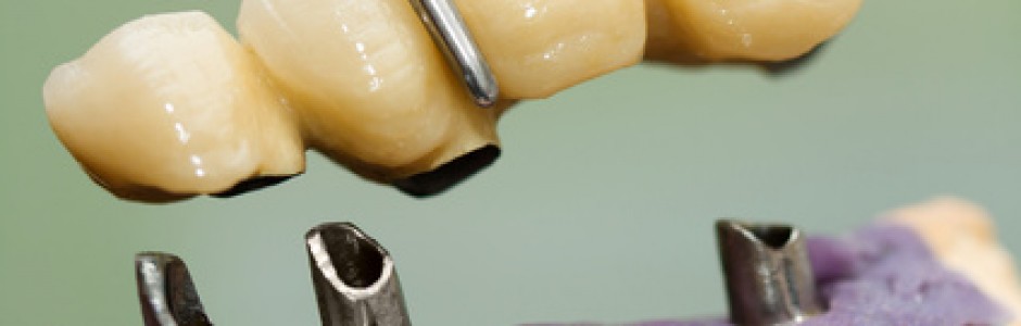 כתרים לקויים בשיניים כתוצאה מרשלנות